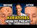 Keratomas (Seborrheic Keratosis): How to Treat?
