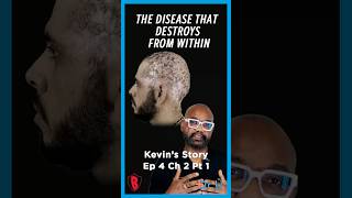 Dissecting Cellulitis Explained | Kevin’s Bumpinator Journey Part 1