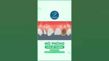 Dán Sứ Veneer với Bác Sĩ Nguyễn Đình Dương để có Nụ Cười HOÀN HẢO