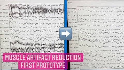 Our First EEG Muscle Artifact Reduction Prototype