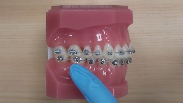 How to apply Class 2 elastics with a fixed brace.