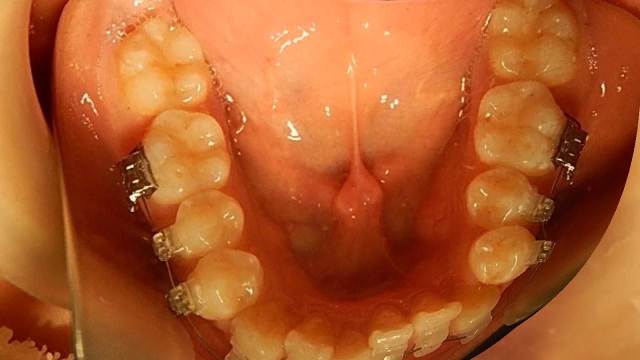 Orthodontic libraryHK. Dental crowdig Protruding teeth Chart No.6448 YouTube