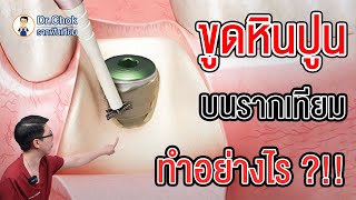 ขูดหินปูน บนรากฟันเทียม ทำอย่างไร ? คลิปนี้มีคำตอบ !! | โชคช่วย กับหมอโชค