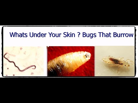 What&rsquo;s Under Your Skin? Bugs That Burrow..................ما تحت جلدك الحشرات التي تختبئ
