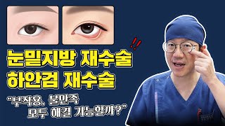 망한 눈밑성형… 재수술로 하안검 부작용 해결 될까요?