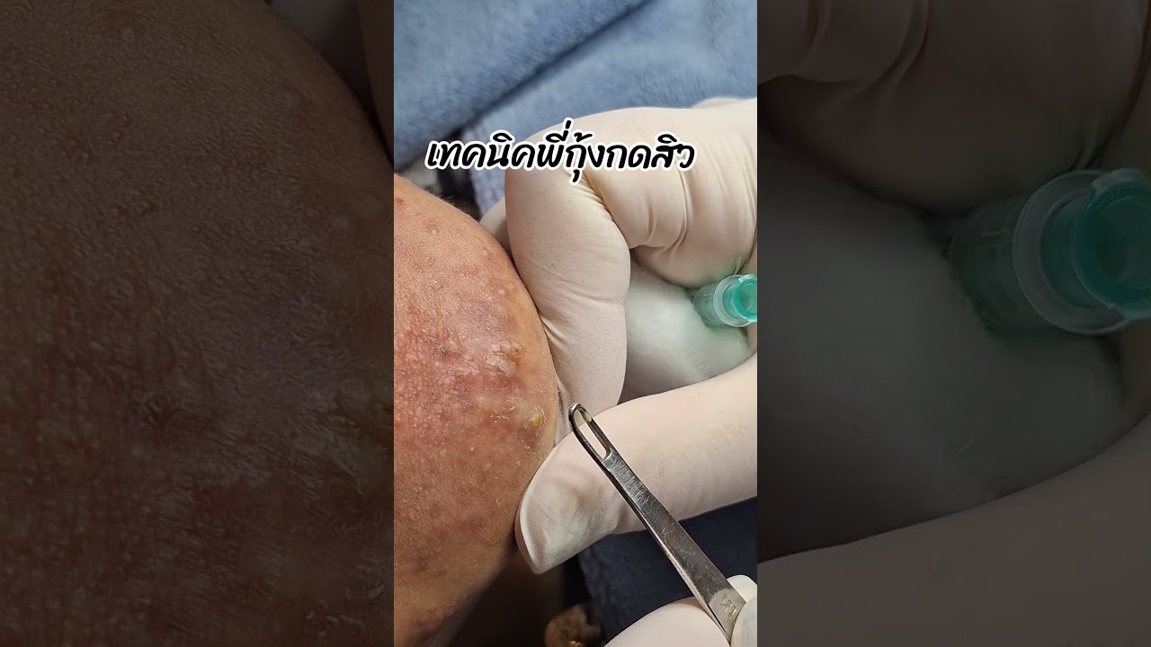 #พี่กุ้งกดสิว #กดสิวอุดตัน #กดสิว กดออกให้ #เทคนิคพี่กุ้งกดสิว ได้หาย #สิว