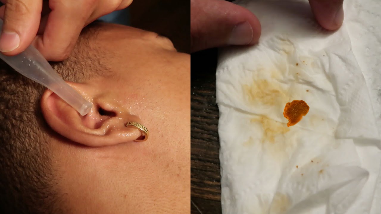 THIS WAS INSIDE MY EAR!!! - YouTube