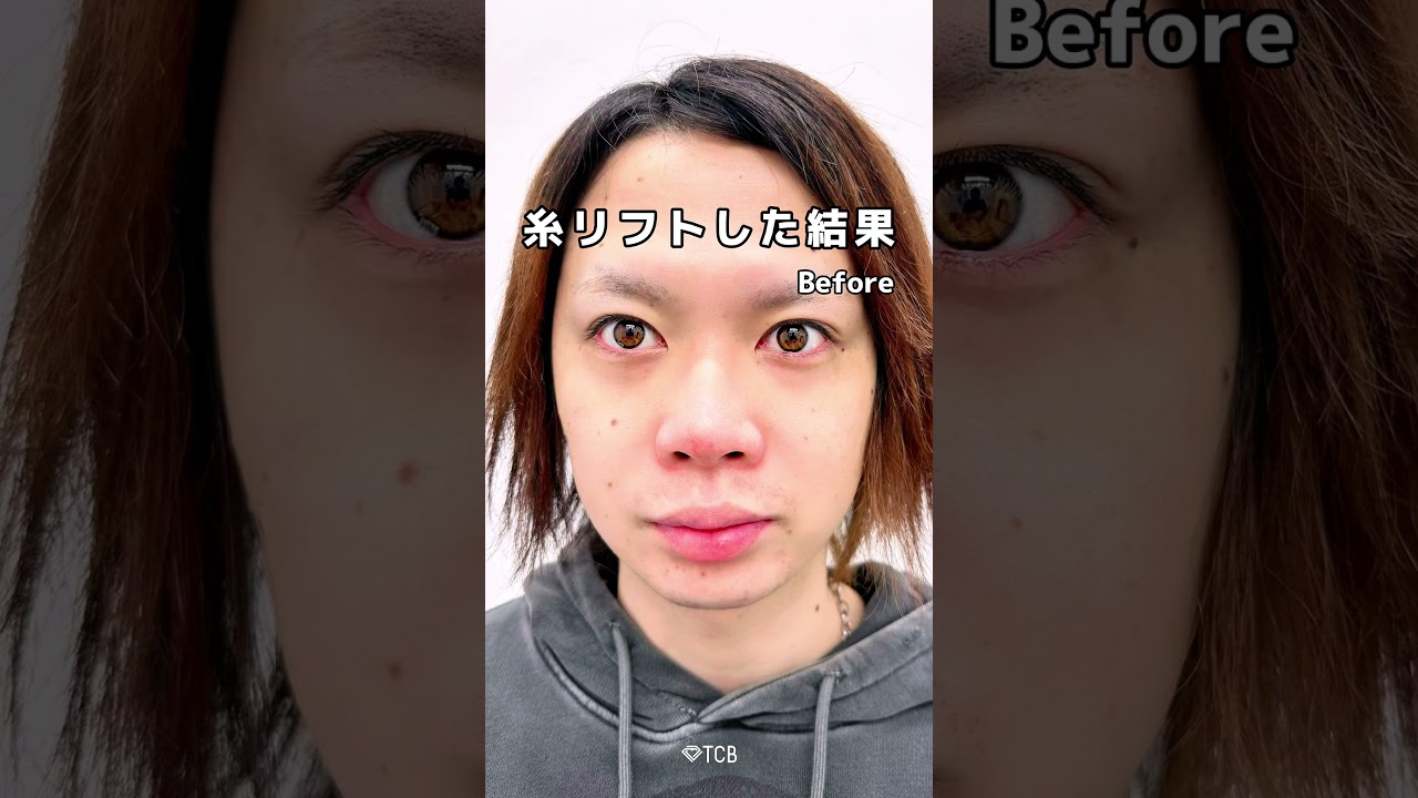 【糸リフト】インフルエンサーが糸リフトした結果