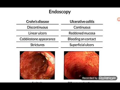 مقاربة مريض الداء المعوي الالتهابي IBD - ٢٠٢١/١٠/٥ - القسم ٢