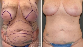 Tummy Tuck FAQ