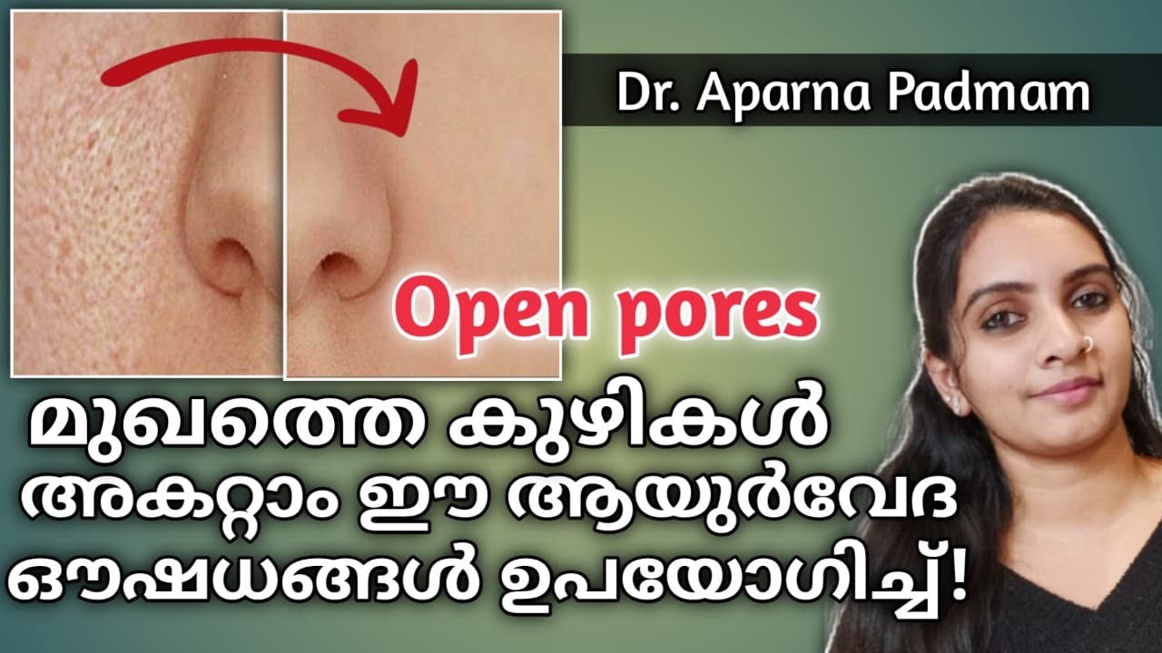 Open pores on face|2 ദിവസം മാത്രം ഉപയോഗിക്കൂ|Ayurveda treatment|ഡോ.അപർണ പത്മം