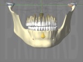 Dam pathologique articulaire  luxation reductible gauche