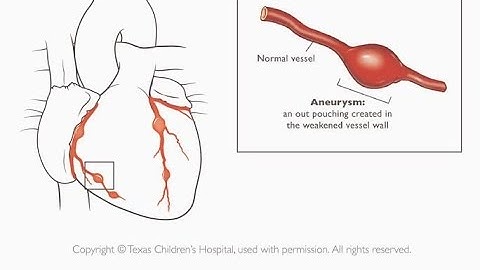 Coronary Aneurysm Stenting