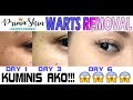 WARTS REMOVAL FULL PROCEDURE AND HEALING PROCESS | PRIMASKIN BEAUTY LOUNGE