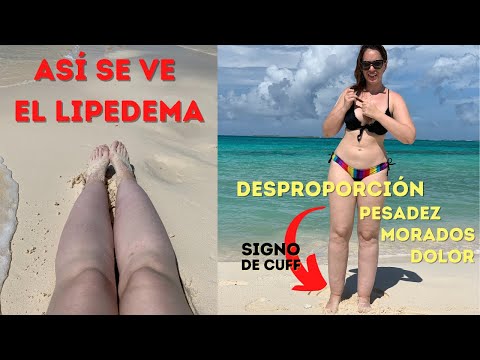 Gladys Seara (@gladys.lipedema) • Instagram photos and videos