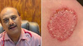 Common Fungal infection or Ring Worm infection #tinea