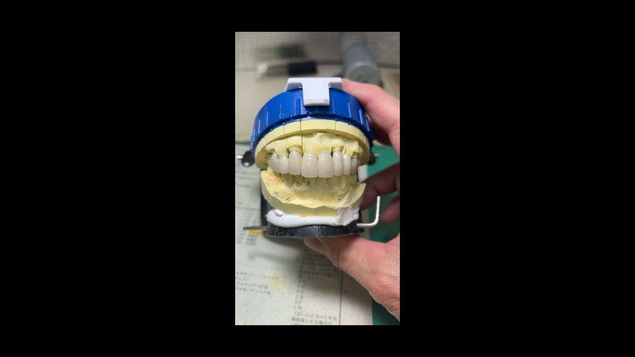 硬質レジン前装ブリッジの製作