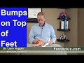 What Causes Bumps on Top of the Feet? Seattle Foot Doctor Larry Huppin