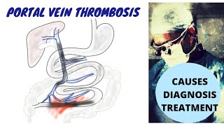 Portal Vein Thrombosis