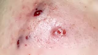 Cystic Acne Extraction | Deep Blackhead Removal & Satisfying Pimple Popping