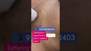 Sufre De Pelos Encarnados En El Área Púbica Y Axilar. ...