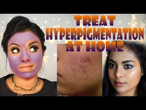 How To Treat Hyperpigmentation, Acne Scars, Remove Suntan - Antiaging face mask at home naturally