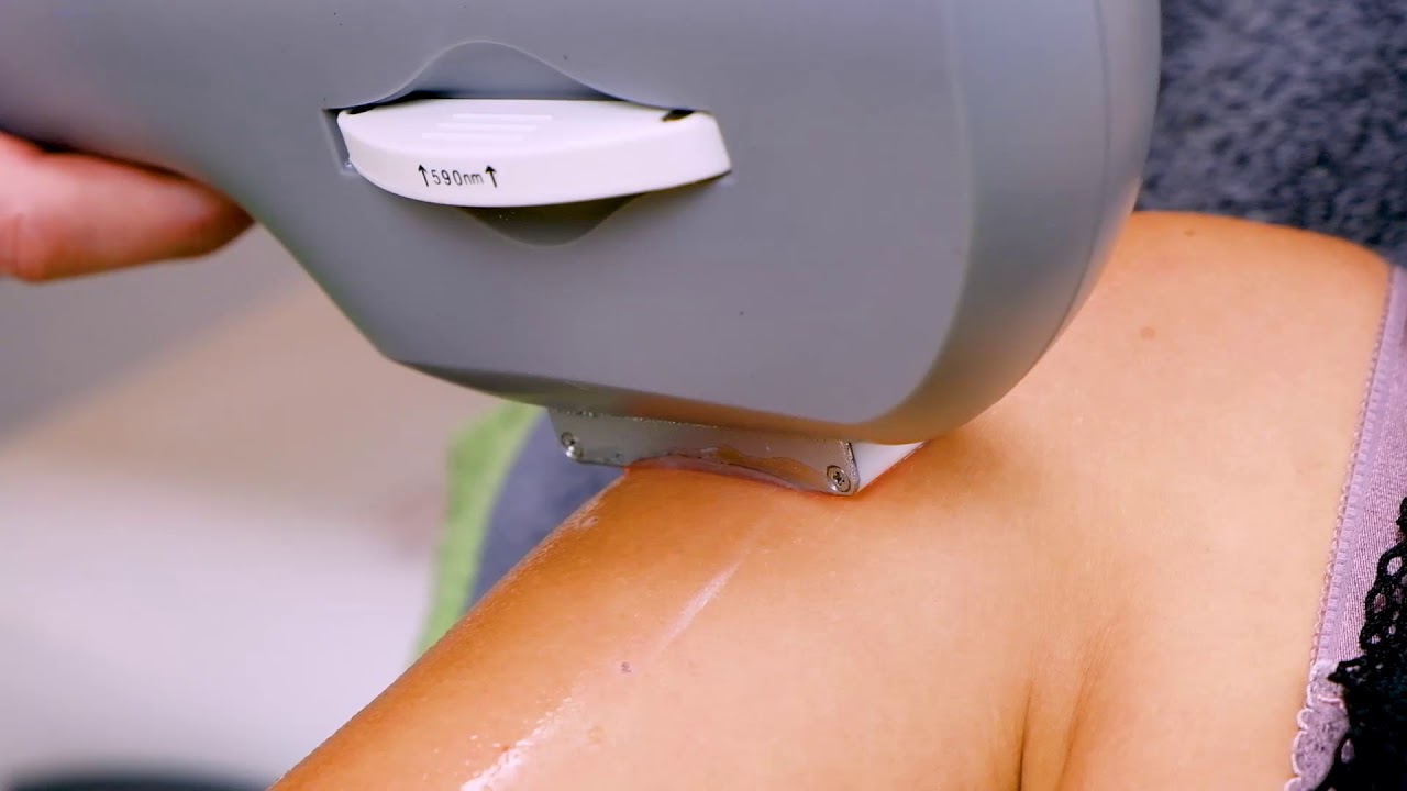 MBC Hyperpulse -  Gerät für dauerhafte Haarentfernung - Behandlung Arme