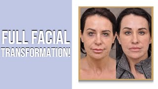 Full Face Transformation From Dr Ben Talei Of Beverly Hills Center For Plastic Surgery
