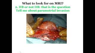 Imaging of Cervix and Endometrial Malignancies