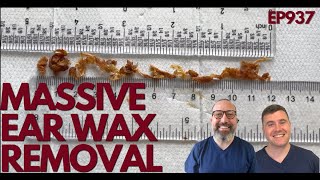 MASSIVE EAR WAX REMOVAL - EP937
