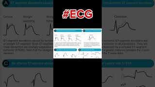 ecg