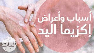 أسباب وأعراض وعلاج إكزيما اليد