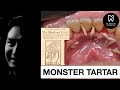 MONSTER TARTAR | DENTIST | DR RIZAL RIZKY AKBAR