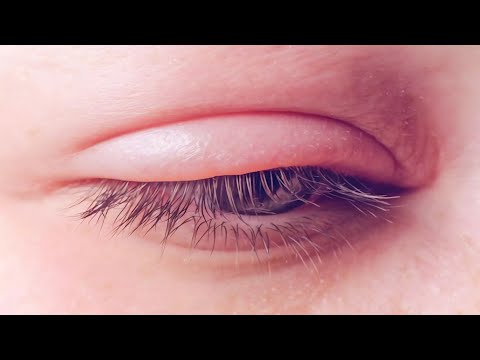 سبب انتفاخ جفن العين العلوي كيف أتخلص منه وما هي أسبابه