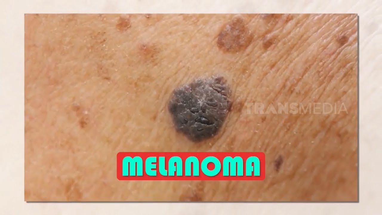 Melanoma, Tumor Ganas Berbahaya | INLINE (30/09/21)
