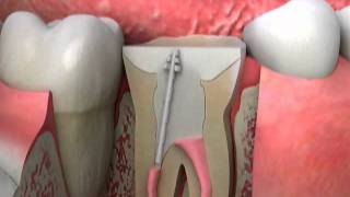 Crowns Post and Core Procedure
