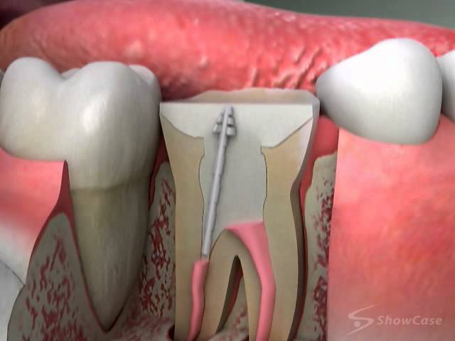 Dental Health - How To Build A Crown Post & Core Procedure