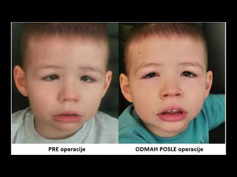Iskustvo pacijenta iz Rijeke, operacija strabizma na oba oka