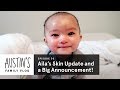 Aila's Skin Update and a Big Announcement! | Austin Vlog | HiHo Kids