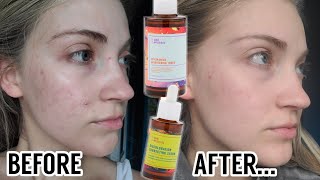 I Tried The Good Molecules Niacinamide Toner Discoloration Correcting Serum For 2 Months