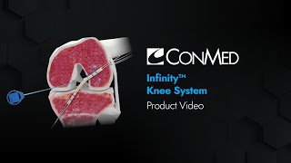 Infinity™ Knee System - CONMED Product Video