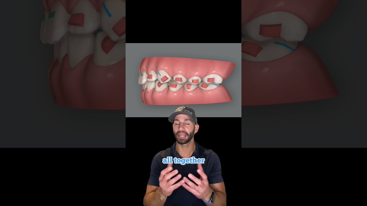 Rubber bands with Invisalign, and overall treatment efficiency. 2023