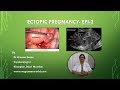 Ectopic Pregnancy ( Video Series-Epi-2)