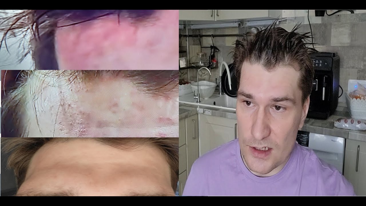 Себорейный дерматит. Как я его вылечил? - YouTube