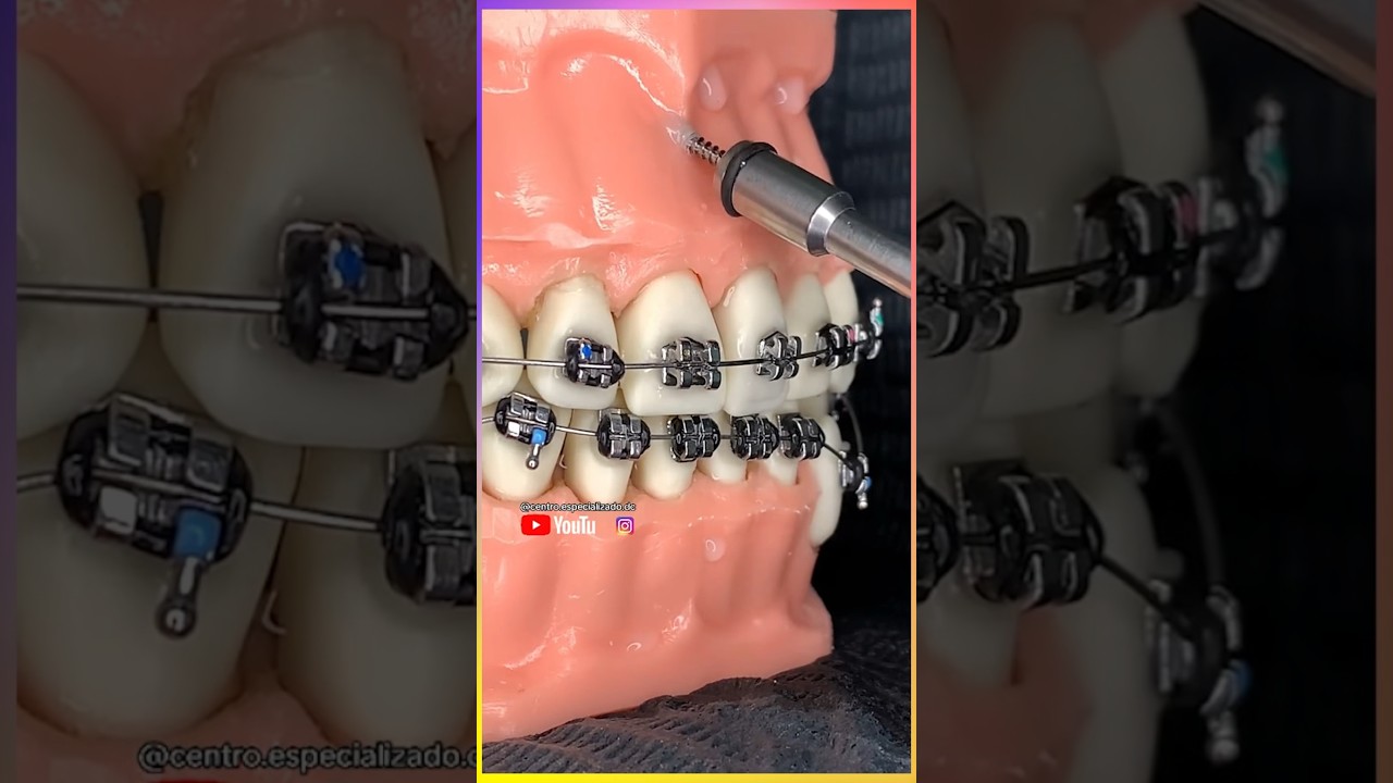 They Drilled Into His Gums?!