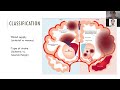 Perinatal Stroke by Dr Richa Tiwari