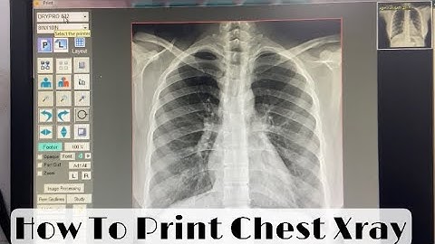 How to Print Chest Xray on IMAGE WORKS SOFTWARE