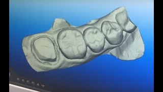 Create a Better Fitting Crown with iTero Digital Impressions