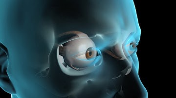 Glaucoma Surgery