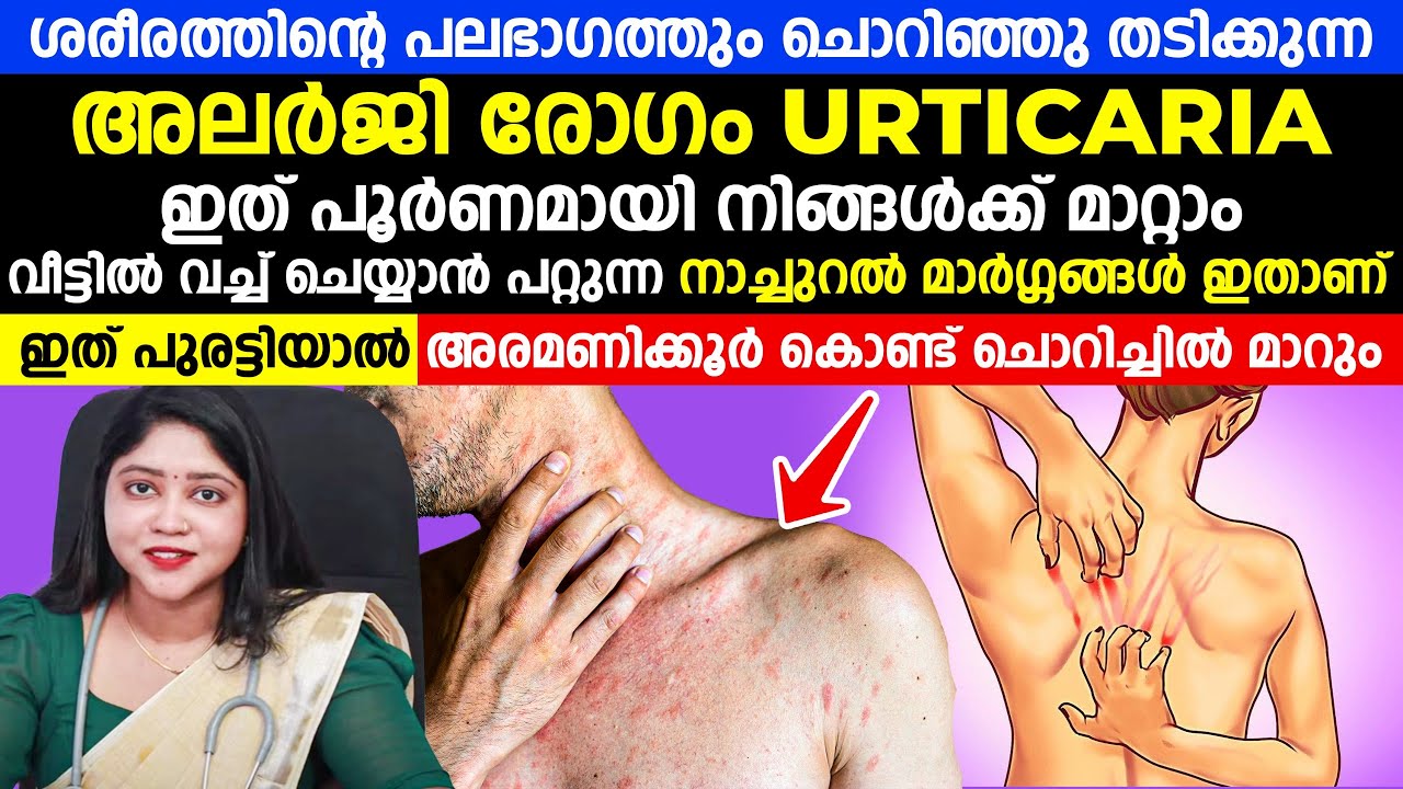 ശരീരത്തിന്റെ പലഭാഗത്തും ചൊറിഞ്ഞു തടിക്കുന്ന അലർജി രോഗം urticaria  ഇത് പൂർണമായി മാറ്റാം